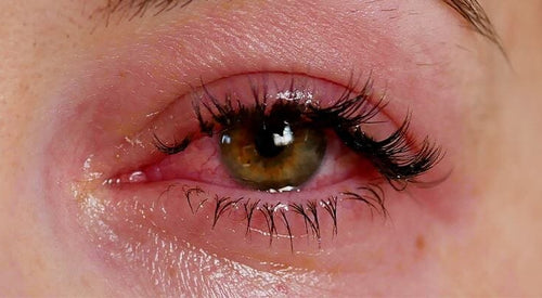 How to Combat Eyelash Extension Glue Allergy